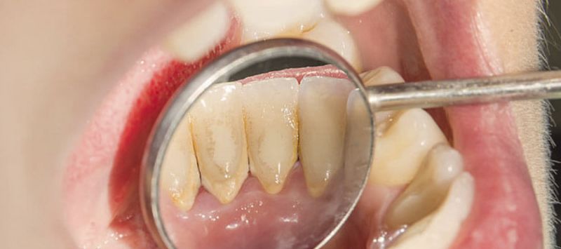 Você sabia? O cálculo dental pode ser a porta de entrada para uma doença periodontal