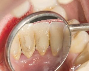 Você sabia? O cálculo dental pode ser a porta de entrada para uma doença periodontal